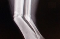Lower leoto fracture ho serapeng sa boikhathollo hammoho (ea litlaleho).